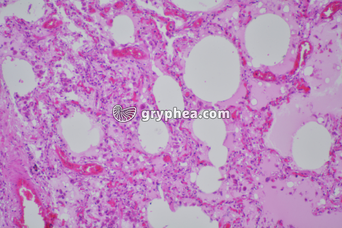 Poumon de fumeur x25 - gryphea.org